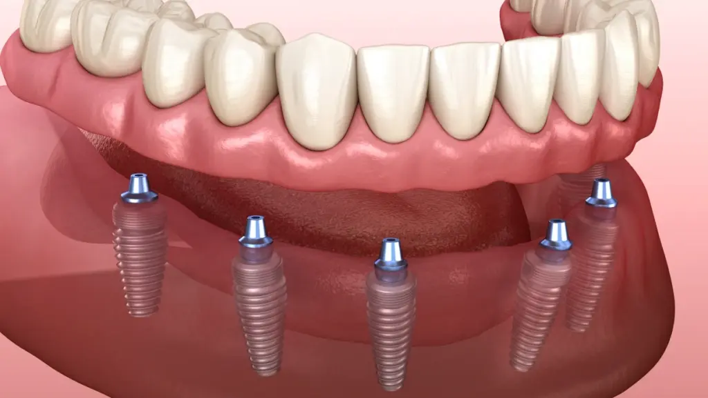 Prothèse sur implant